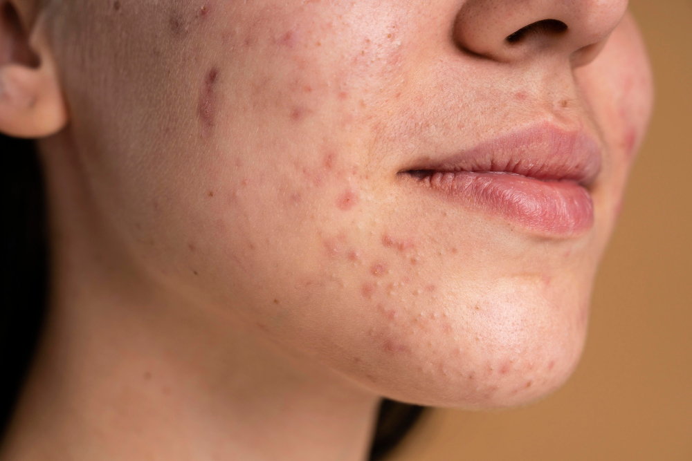 best Acne Scar Treatment in Bangalore