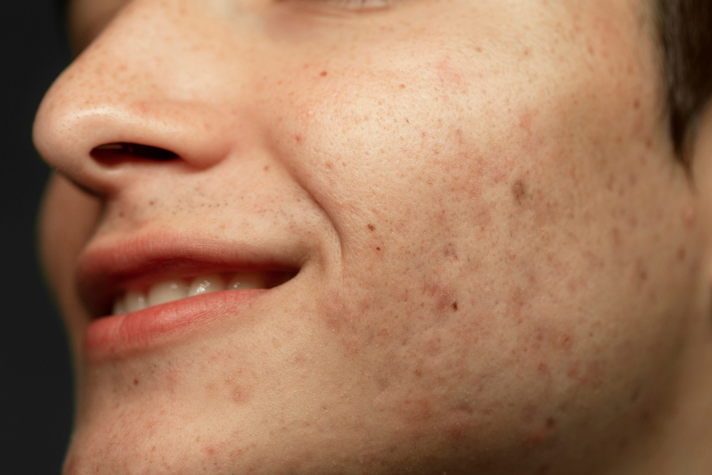 best Acne Scar Treatment in Bangalore