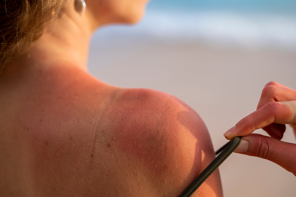 best Sun Damage Treatment in Bangalore